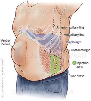  Abdominal wall injection zone 