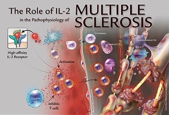  Daclizumab Multiple Sclerosis Poster 