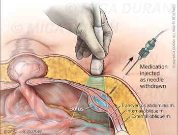  Injection technique abdominal wall hernia 