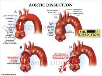  Aortic Dissection 
