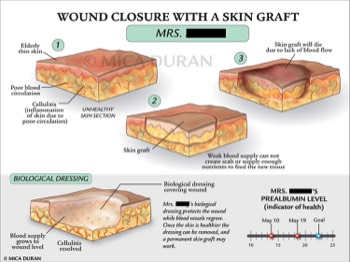  Wound Closure with Skin Graft 