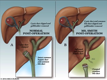  Gallbladder Cholecystectomy Post-Op Condition 