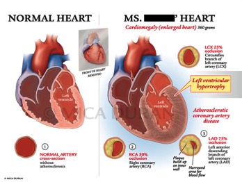 Decedent's Heart vs Normal Heart 