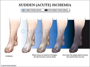  Sudden Acute Ischemia of Foot 