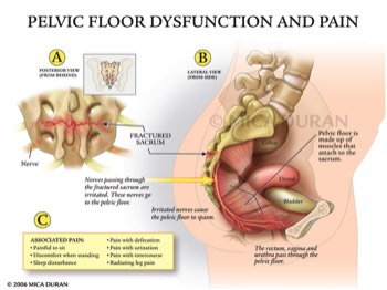  Pelvic Floor Dysfunction and Pain 