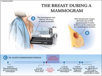  Breast During a Mammogram 