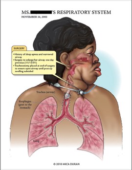  Respiratory System with Tracheostomy 