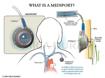  What is a Mediport 