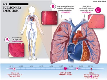  Pulmonary Embolism Pathology and Timeline 