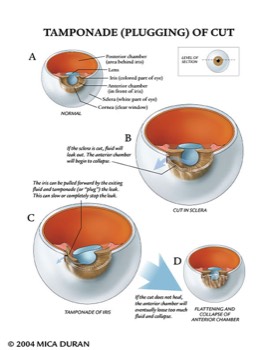  Tamponade of Iris of Eye 