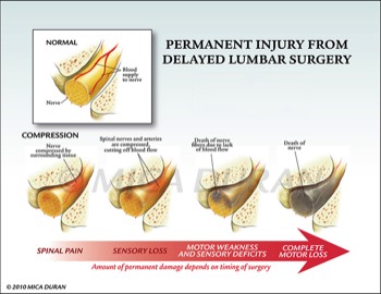  Injury to Nerve from Delay of Surgery 