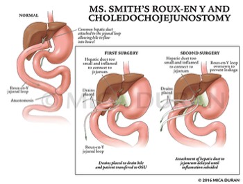  Roux-en Y and Choledochojejunostomy 