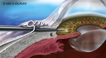  Xen Gel Stent implant 