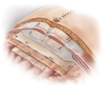  Gentrix Abdominal Mesh Locations 