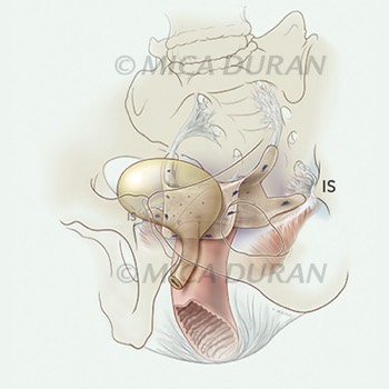  Booth Graphic for Prolapse Mesh Repair 